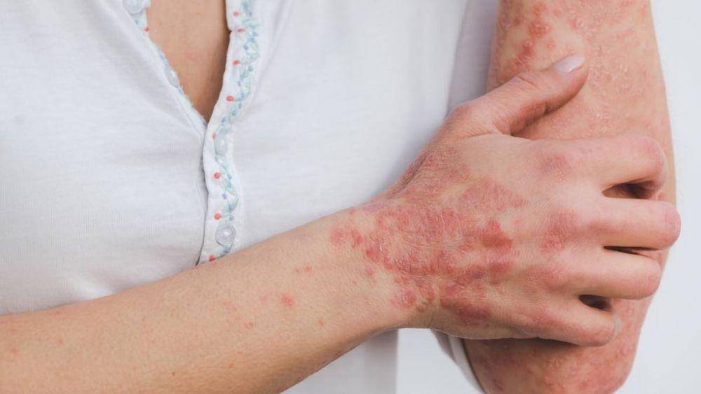 ilustrasi psoriasis (medicine.com)