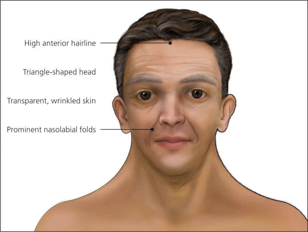 ilustrasi pasien sindrom Noonan (aafp.org)