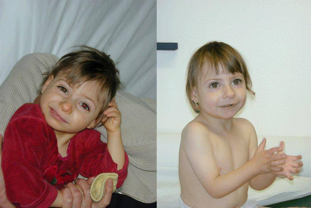 ilustrasi anak dengan microcephalic osteodysplastic primordial dwarfism (MOPD) (europepmc.org)