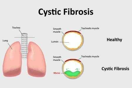 ilustrasi fibrosis kistik (yashodahospitals.com)