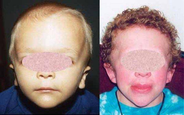 ilustrasi anak dengan sindrom Wiedemann-Rautenstrauch (medlineplus.gov)