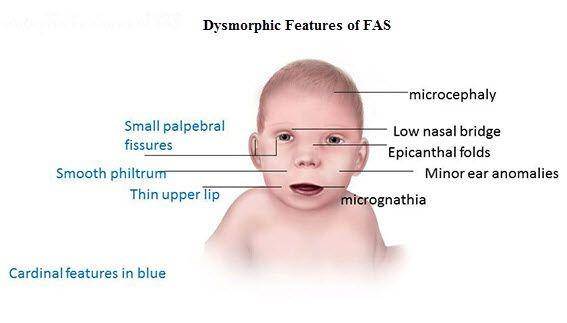 ilustrasi tanda-tanda FAS (healthychildren.org)
