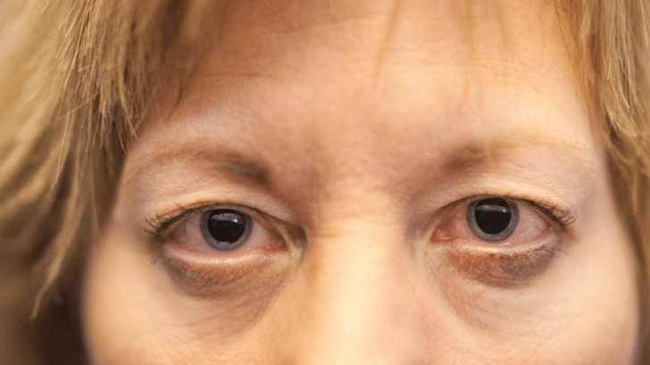ilustrasi perempuan dengan sindrom Adie (eyepaincenter.com)