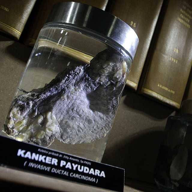 Museum Kanker Indonesia (instagram.com/yachyaiman)