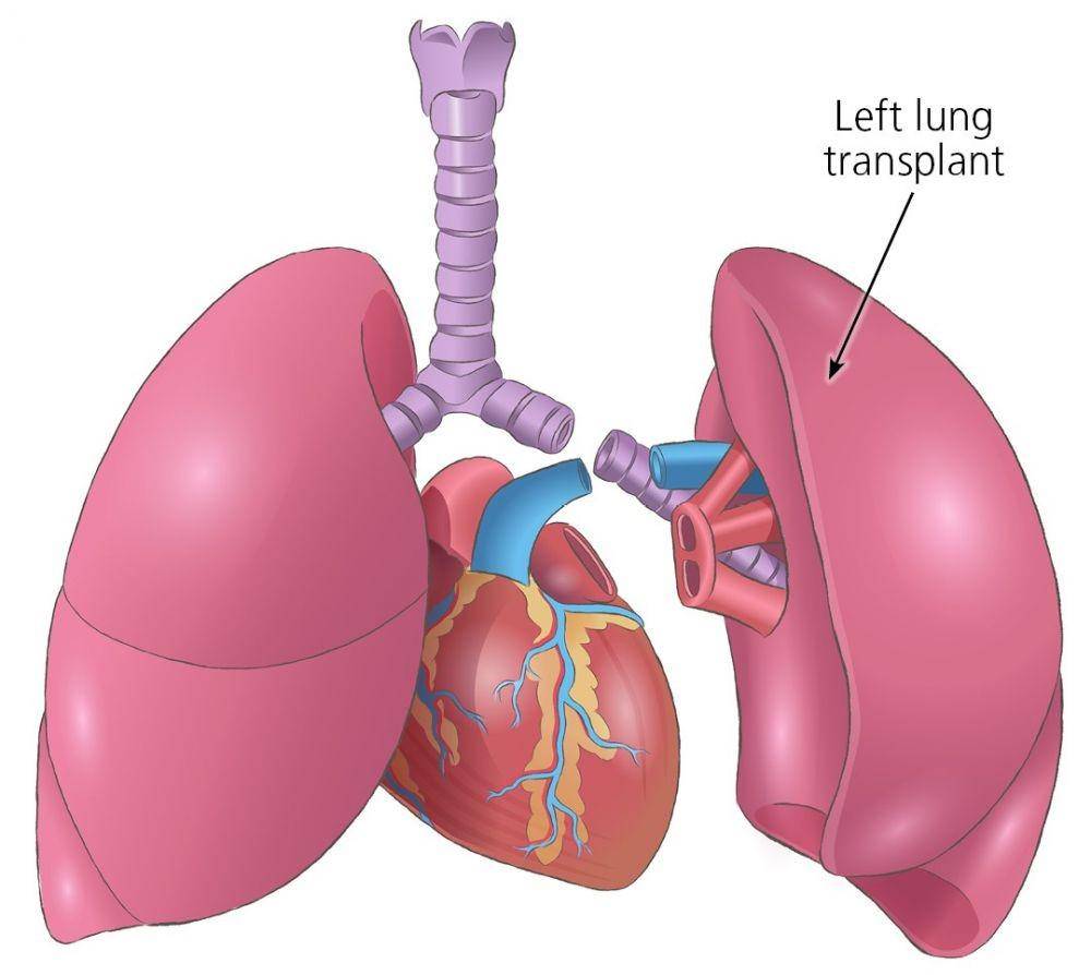 ilustrasi transplantasi paru-paru tunggal (nhsbt.nhs.uk)