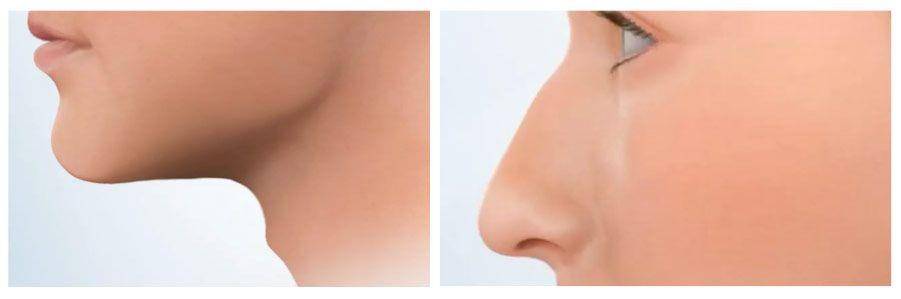 proses operasi hidung dan juga dagu (ohniww.org)