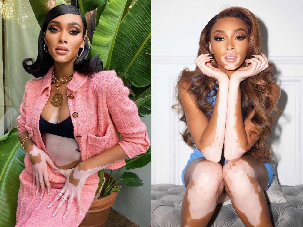 9 Potret Menawan Winnie Harlow Model Pengidap Vitiligo yang Inspiratif