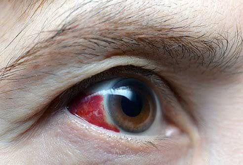 ilustrasi hifema (emedicinehealth.com)