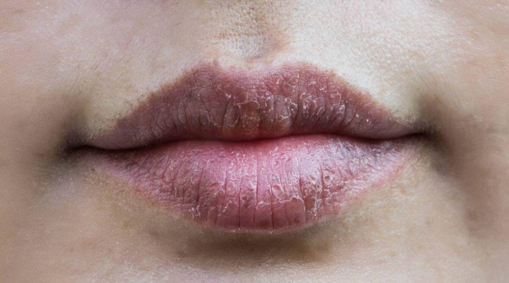 5 Penyebab Bibir Gelap dan Kusam Padahal Tidak Merokok