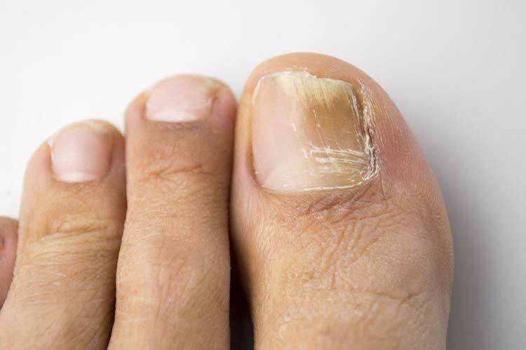 ilustrasi infeksi kaki (mydr.com.au)