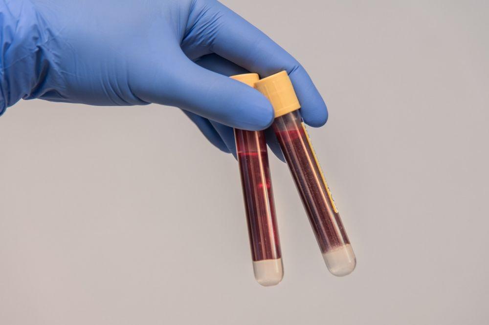 Apa Itu Anemia Aplastik? Ini Penyebab hingga Pengobatannya