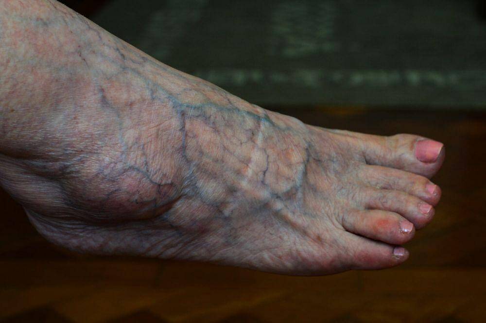 urat terlihat di kaki (theveininstitute.com.au)