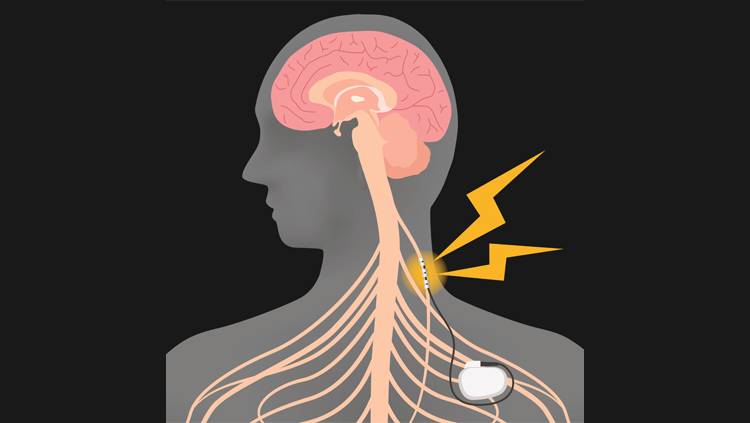 ilustrasi simulasi saraf vagus (brainfacts.org)