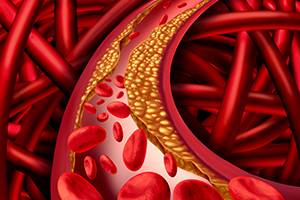 ilustrasi kolesterol (myhealthmylife.com.my)