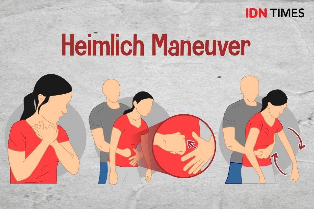 ilustrasi manuver Heimlich (IDN Times/Sukma Shakti)