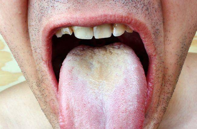 ilustrasi oral thrush (clevelandclinic.org)