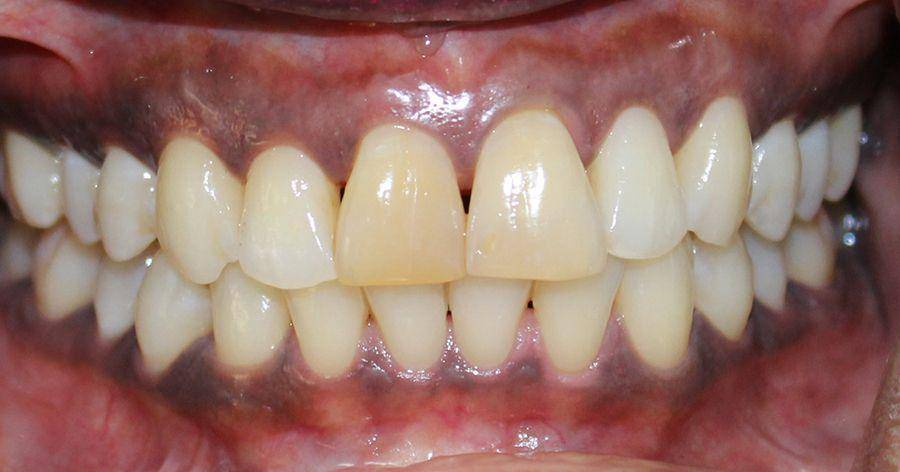 ilustrasi hiperpigmentasi gingiva (northlandprosthodontics.co.nz/)