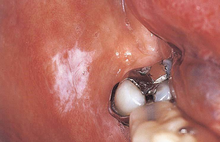 ilustrasi frictional keratosis (dental-science.com/)