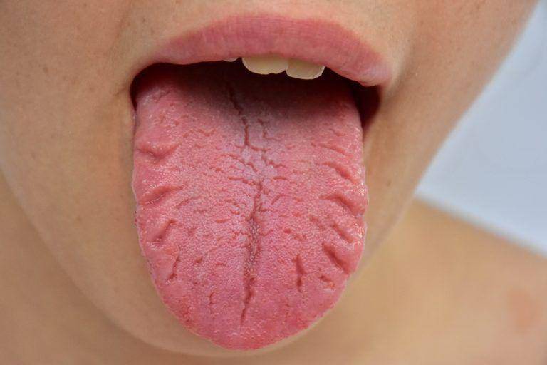 ilustrasi fissured tongue (revisedental.com/)