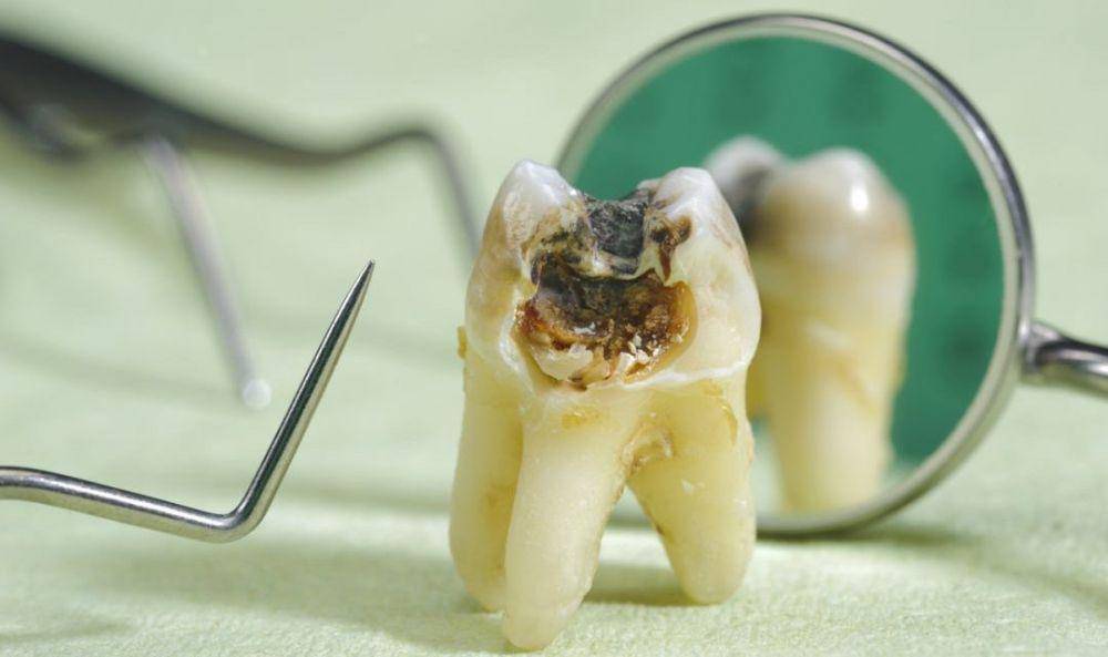 ilustrasi karies gigi (stlawrencedentistry.com)