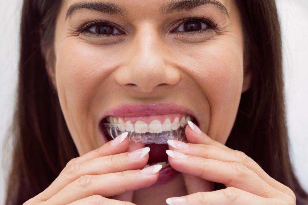 Apakah Invisalign Benar-benar Ampuh Merapikan Gigi? Ini 5 Faktanya