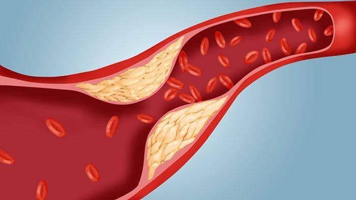 ilustrasi kolesterol (myheart.net)