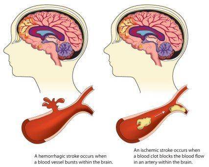ilustrasi kondisi pembuluh darah saat stroke (cdc.gov)