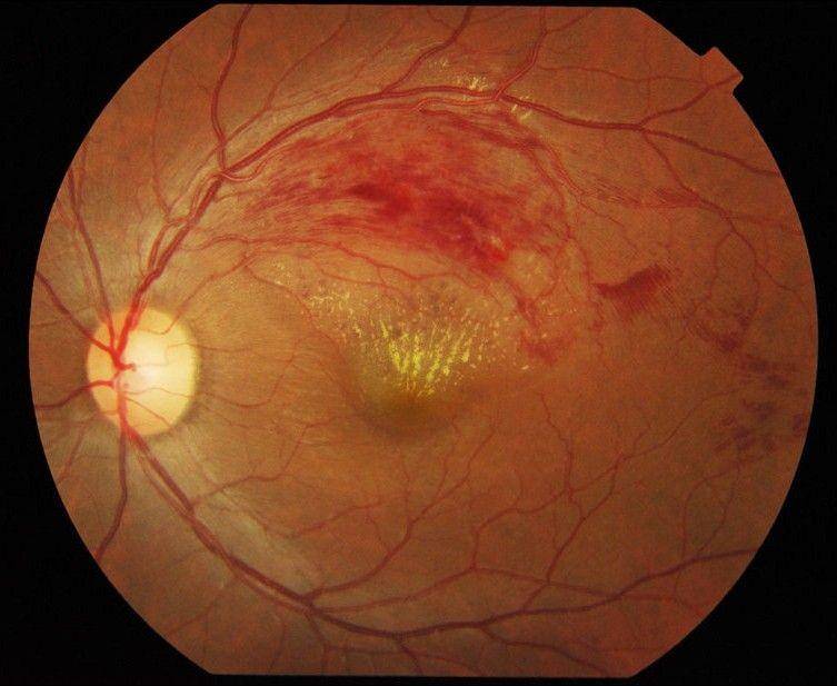 ilustrasi tampilan oklusi vena retina (wikimedia.org)