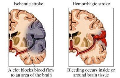 ilustrasi dua jenis stroke (uclahealth.org)