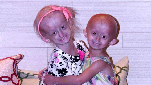 potret dua anak penderita Progeria Hutchinson-Gilford Syndrome (pratt.duke.edu)
