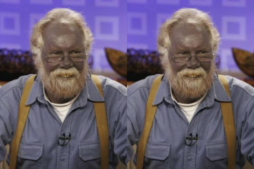 potret Paul Karason yang merupakan salah satu penderita Methemoglobinemia (starcasm.net)