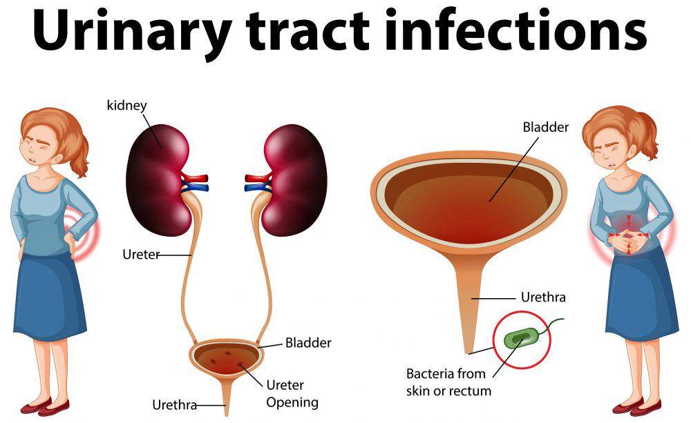 ilustrasi gejala uretritis (freepik.com/Brgfx)