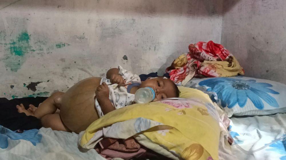 Aiyla, Bayi 7 Bulan yang Kena Atresia Bilier Butuh Bantuan