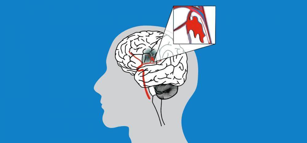 ilustrasi stroke hemoragik (strokefoundation.org.au)