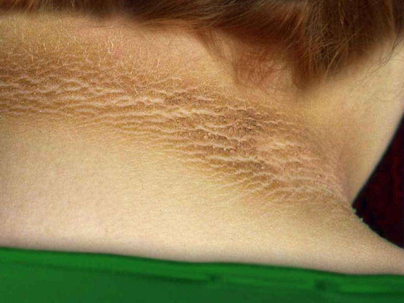 ilustrasi acanthosis nigricans (ncbi.nlm.nih.gov/Contributed by Scott Dulebohn, MD)