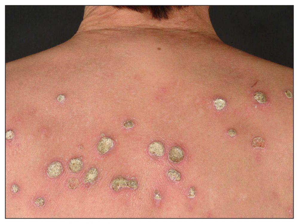 ilustrasi plak acquired reactive perforating collagenosis/ARPC (cmaj.ca)