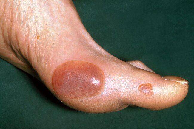 ilustrasi bullosis diabeticorum (yeswecannewspaper.com)