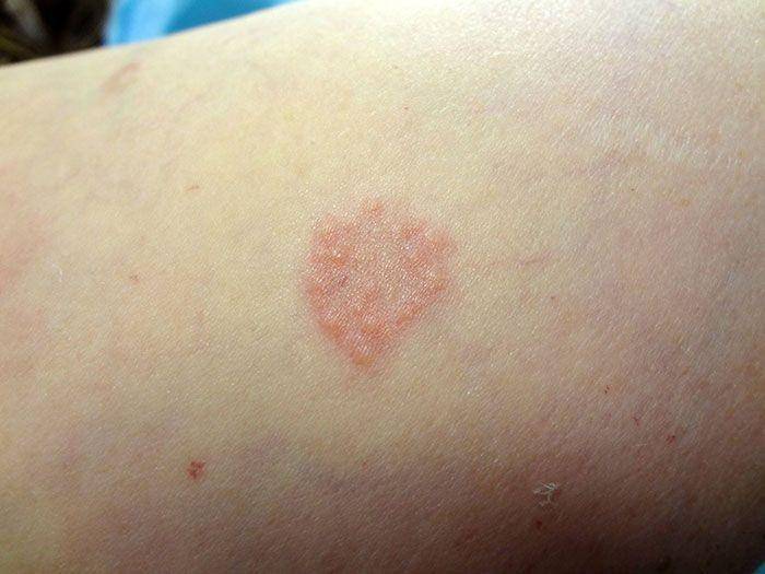ilustrasi granuloma annulare (patientcareonline.com)
