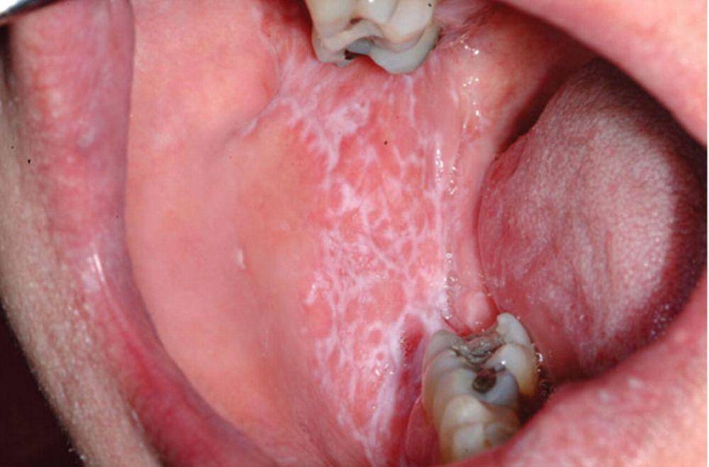ilustrasi lichen planus di dinding mulut (spectrum.diabetesjournals.org)