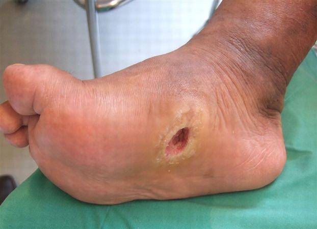 ilustrasi diabetic foot syndrome (orthobullets.com)