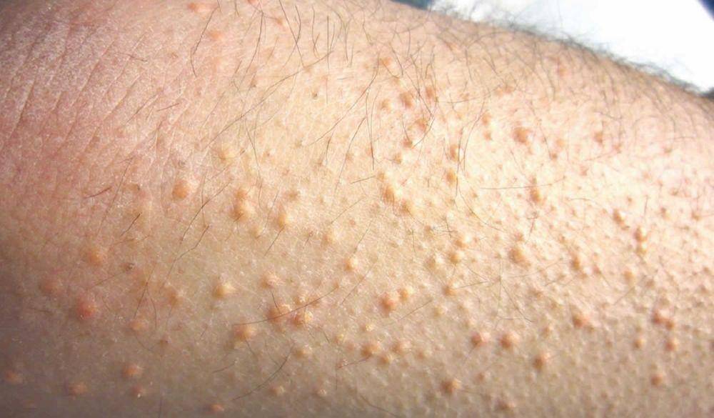 ilustrasi xantoma erupsi (healthjade.net)