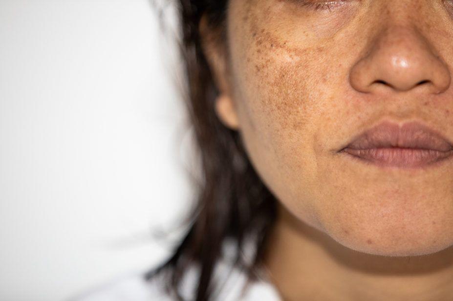 Melasma: Penyebab, Gejala, Jenis, Diagnosis, dan Pengobatan