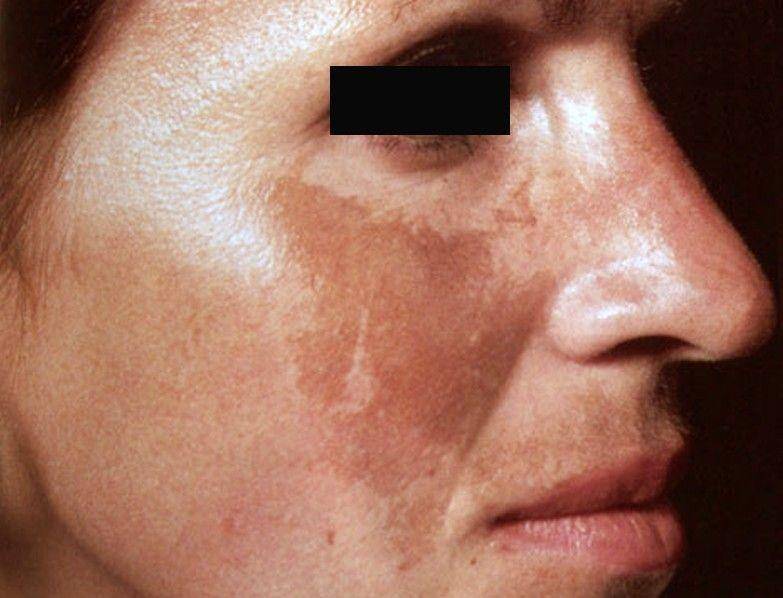 ilustrasi melasma (skinofcolorsociety.org)