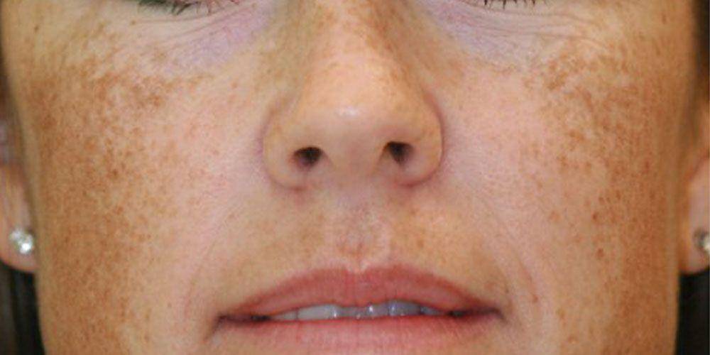 ilustrasi melasma (arlingtonskindoctor.com)