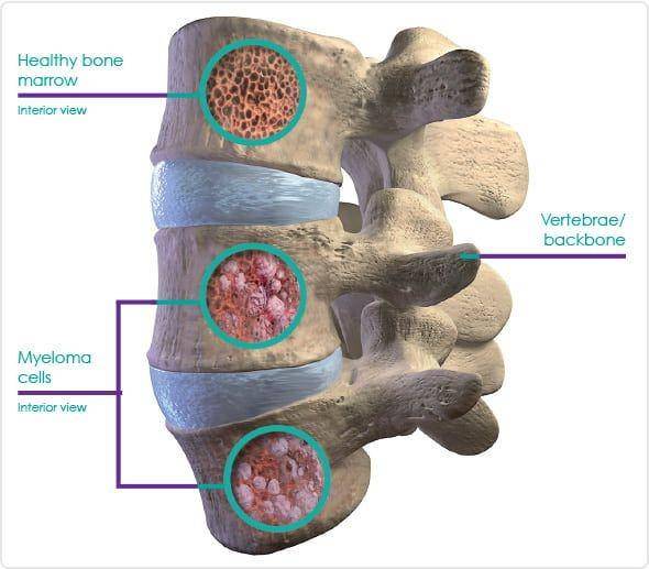 ilustrasi multiple myeloma (darzalex.com)