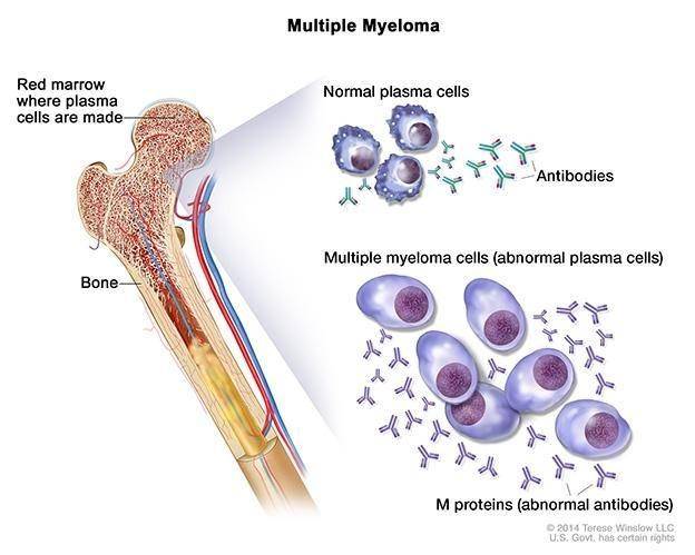 ilustrasi multiple myeloma (cancersupportcommunity.org)