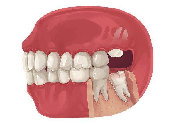 ilustrasi gigi bungsu (kallangurdental.com.au)