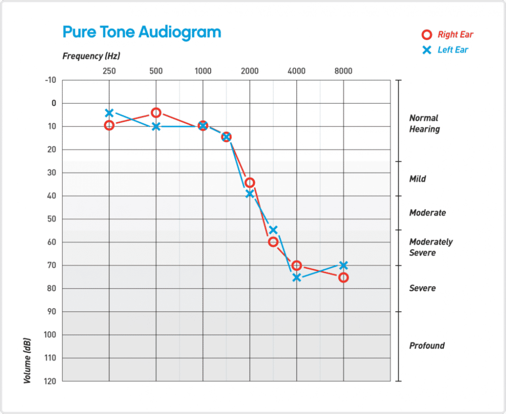 ilustrasi audiogram tes pendengaran (hear.com)