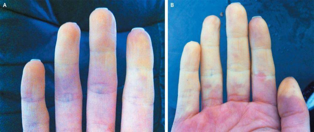 ilustrasi fenomena Raynaud primer (nejm.org/Michael Rodgers, M.D.)