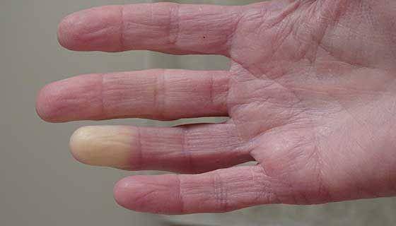 ilustrasi fenomena Raynaud di jari tangan (hopkinsmedicine.org)